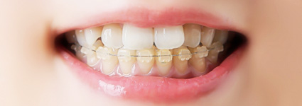 女性の矯正中の歯